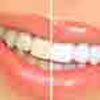 Teeth Whitening Small